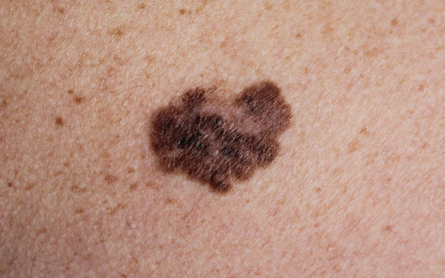 Invasive Melanoma