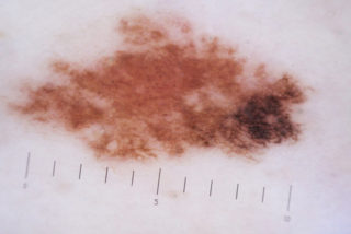 Melanoma-in-situ arising in a Mole