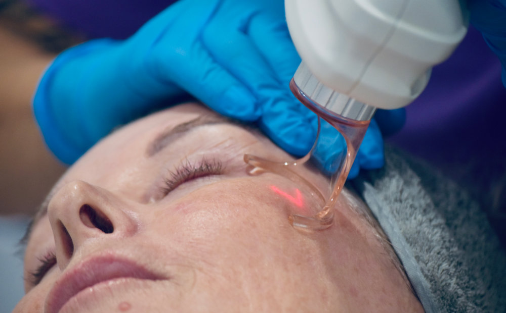CO2 Laser Mole Removal