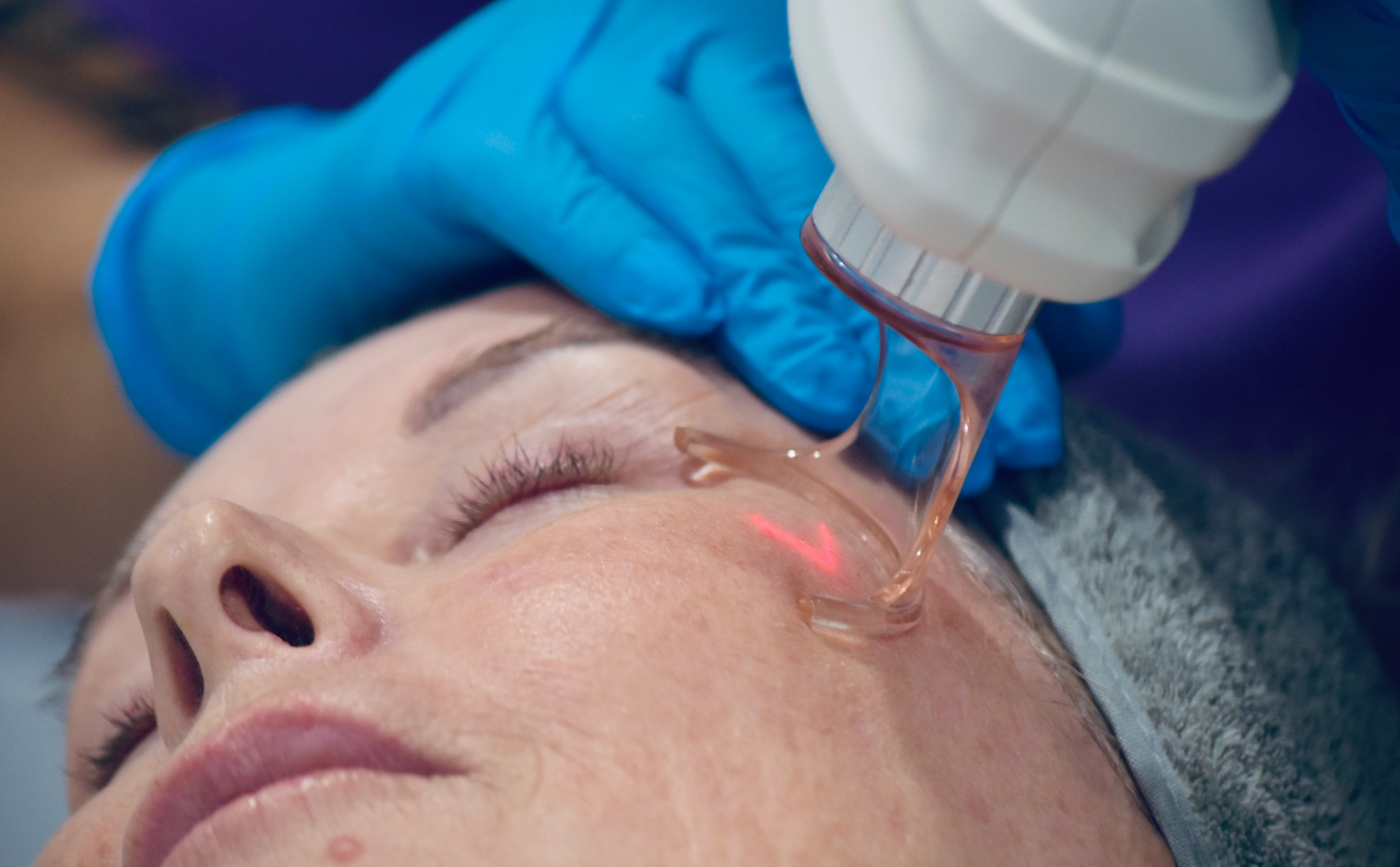 co2-laser-skin-rejuvenation