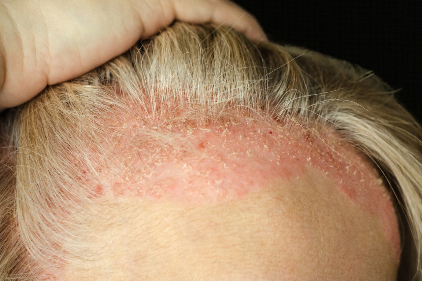 Psoriasis Scalp