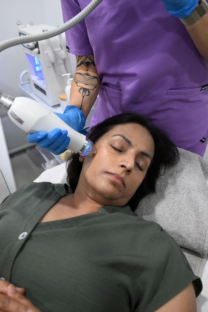 Radio Frequency Microneedling Treatment