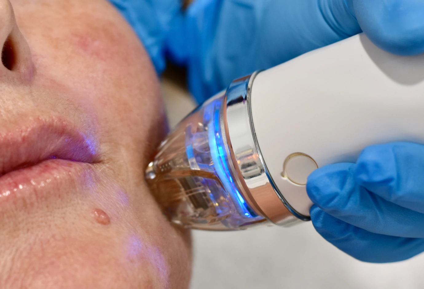 Radio Frequency Microneedling