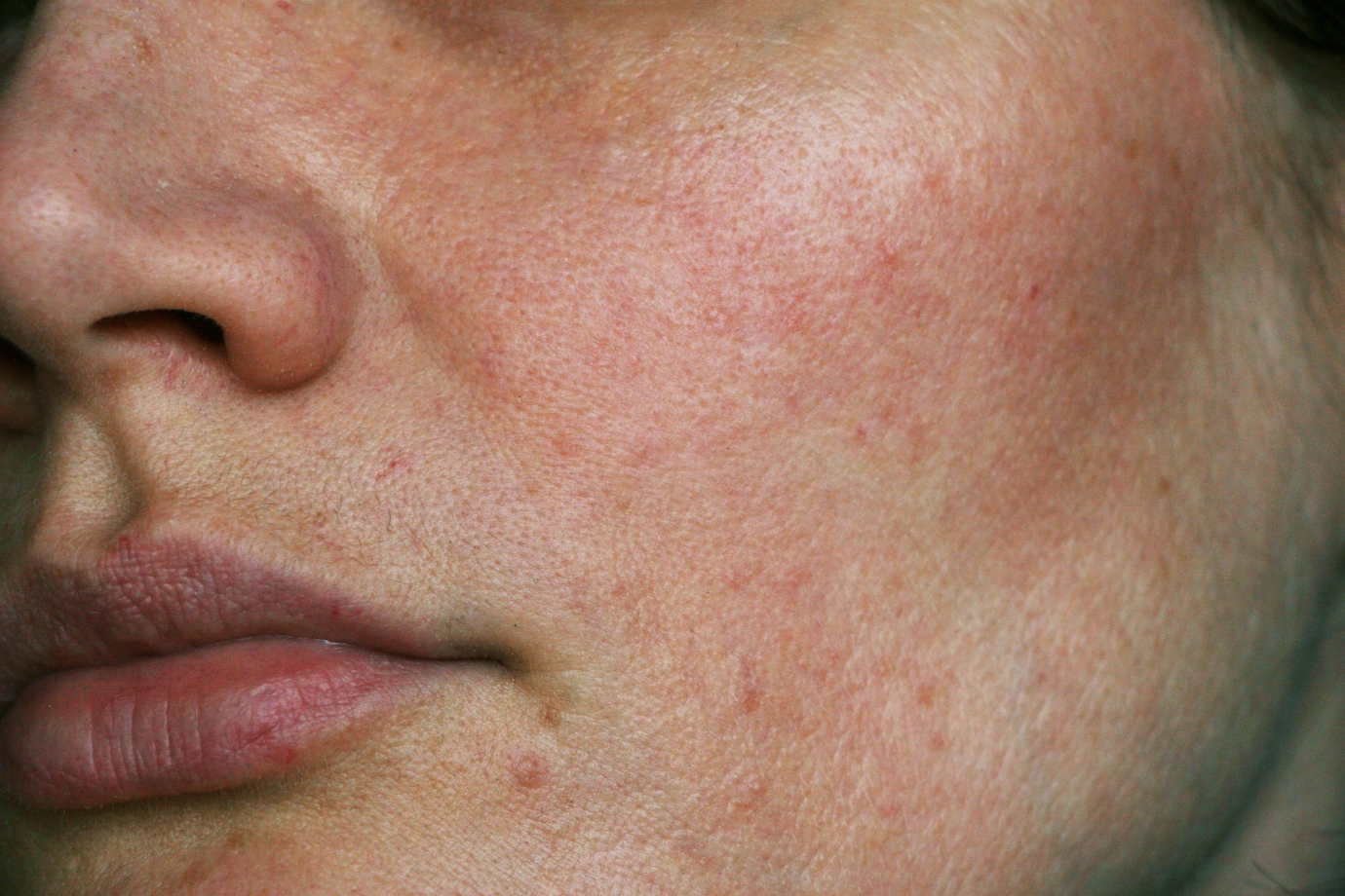 Rosacea