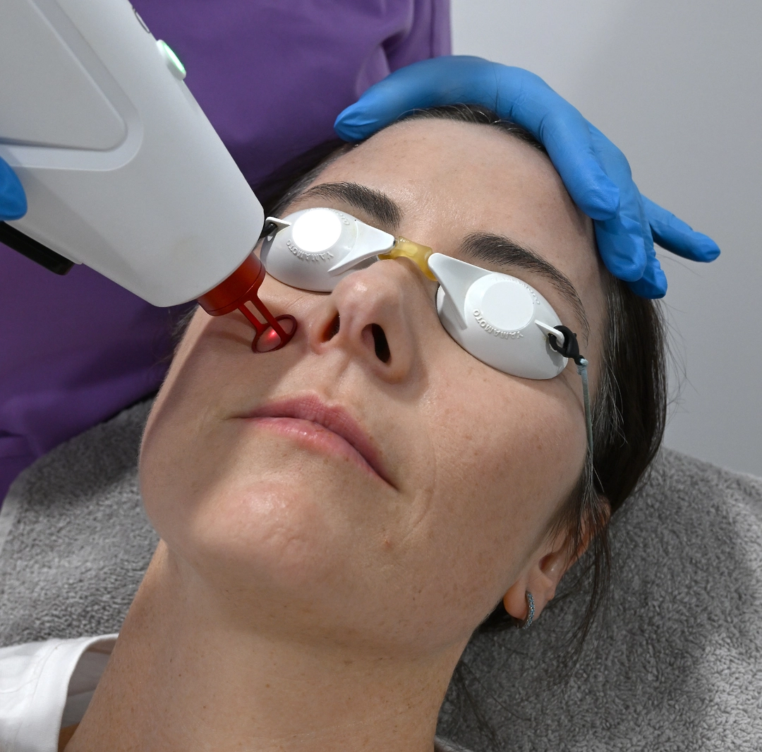 Cheery Angioma Treatment 